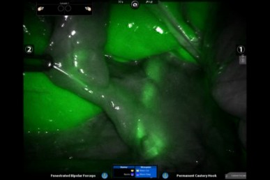 Gallbladder under near-infrared light