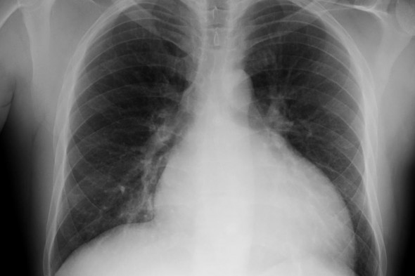 x-ray of Pulmonary Hypertension