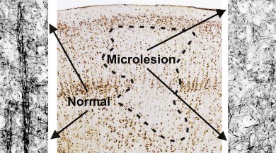 Microlesions