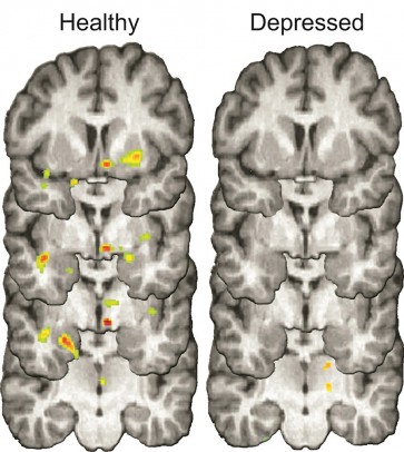 Depression - Rejection reaction brain scans