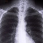 x-ray of a human chest