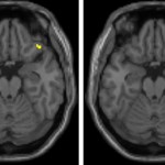 Two brain scans with different areas highlighted