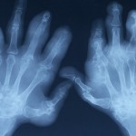 x-ray of arthritic hands