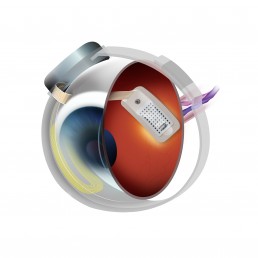 Argus Retinal Implant diagram