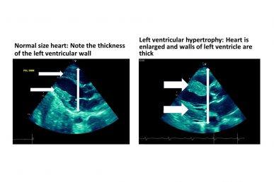 heart ultrasounds