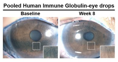 Patients treated with antibody-based eye drops