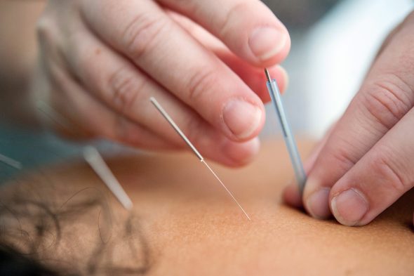 Acupuncture with needles showing.