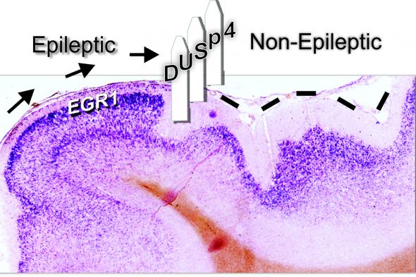 The DUSP4 protein is located on the border between epileptic and