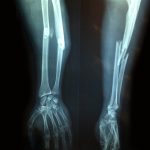 Fracture Bone. Dr. Manuel González Reyes from Pixabay