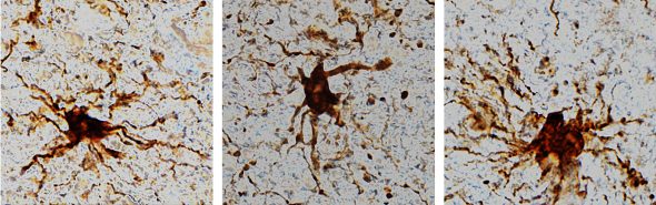‘Zombie’ cells come to life after death of the human brain. (Image: Dr. Jeffrey Loeb/UIC).  