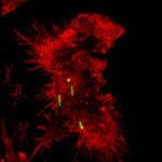 Macrophage (red fluorescent staining) that has ingested bacteria (green fluorescence).