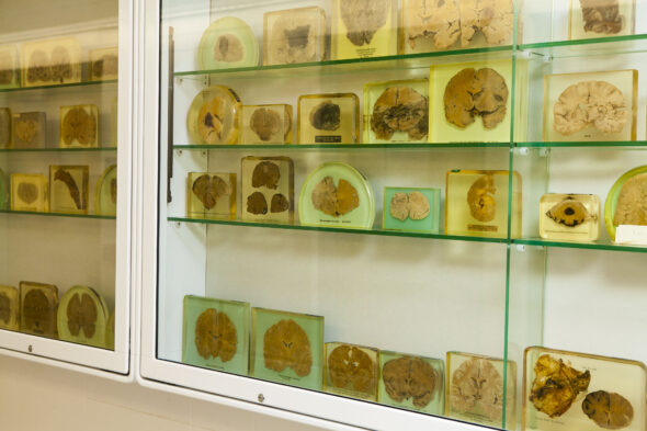 A glass case containing glass-enclosed samples of brain tissue.